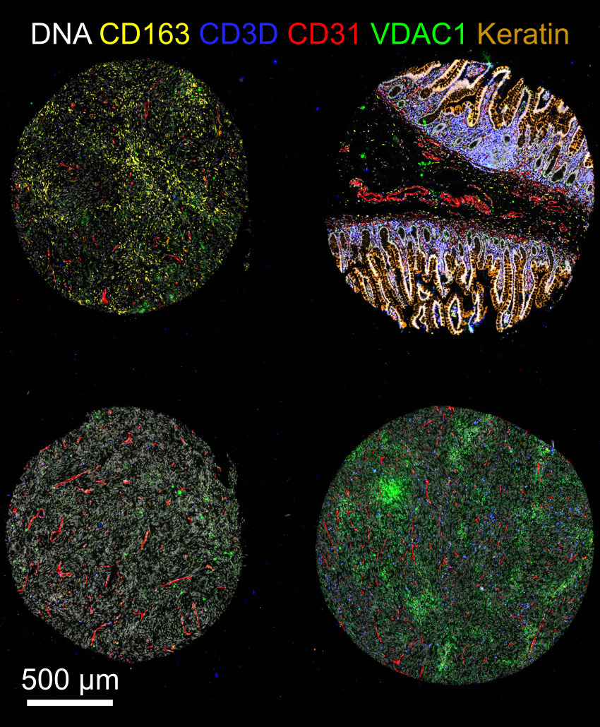 Image of exemplar data 2, showing four cores from a tissue microarray, stained with CD163, CD3D, CD31, VDAC1, and Keratin